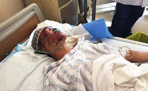 Zhou Ti bị bỏng ở mặt và hiện được điều trị tại bệnh viện. SCMP.