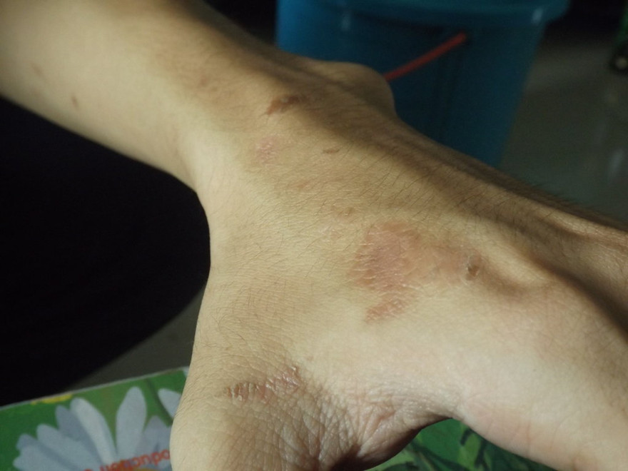 Khi bị kiến ba khoang tấn công, độc tố của loại kiến này thường khiến vết thương lở loét, có thể để lại sẹo.