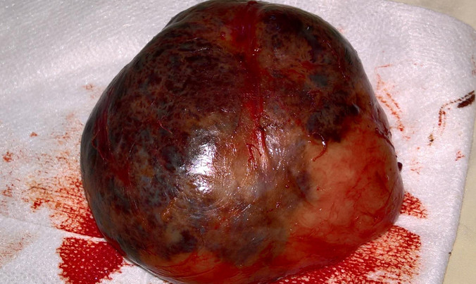 Hình ảnh khối bướu ở ngực trái bé gái 9 tuổi khi được lấy ra. Ảnh do bệnh viện cung cấp.