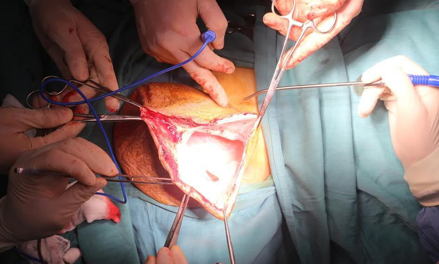 Khối u 4kg trên người bệnh nhân Nguyễn Văn Giảng.