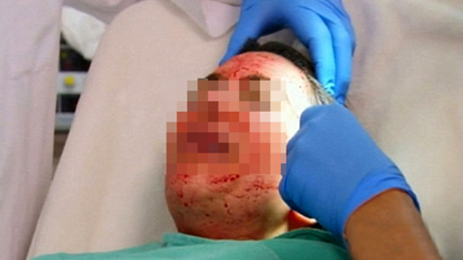 Sau li tâm, phần huyết tương tiểu cầu (phần ở giữa) sẽ được tiêm vào da