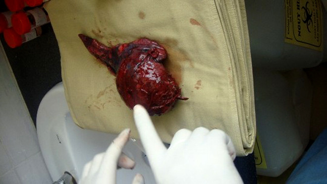 Khối u phổi khổng lồ vừa lấy ra khỏi lồng ngực bệnh nhân