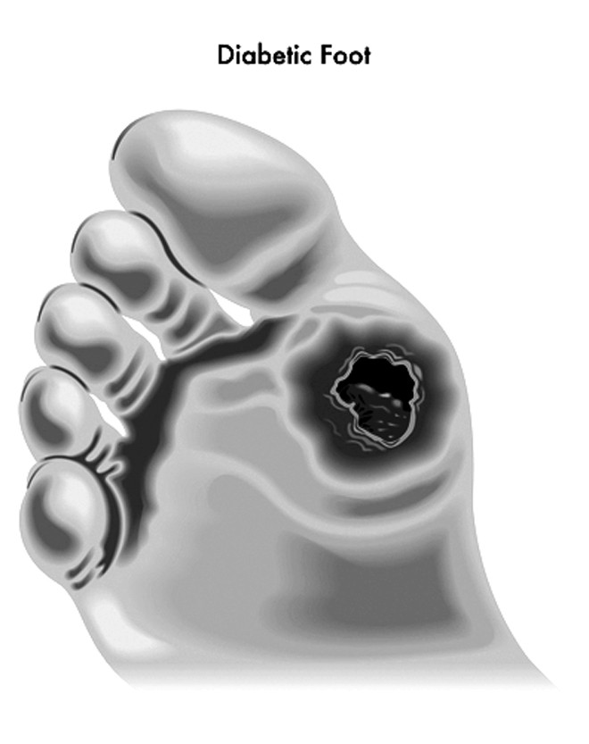 Bàn chân biến chứng tiểu đường