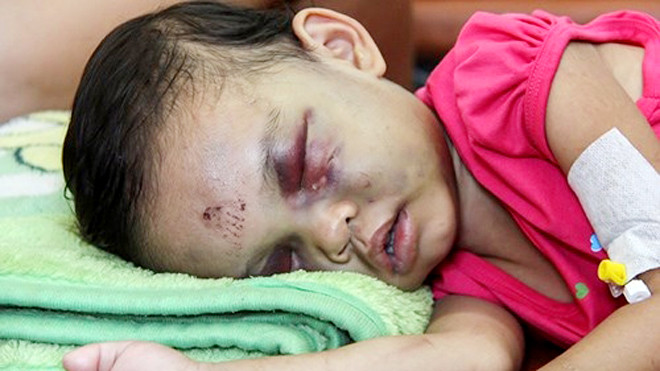 Bé Đỗ Thị Kim Ngân bị mẹ ruột đánh đập dã man