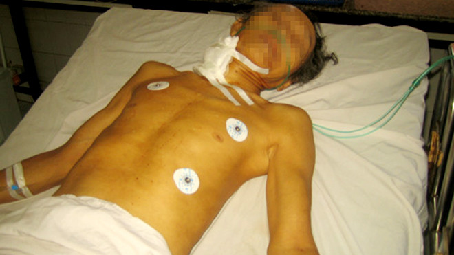 Ông Phạm Văn Bảy đang cấp cứu tại Bệnh viện đa khoa tỉnh Bình Phước