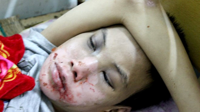 Mặt cháu Tú bị nhiều thương tích vết bỏng 