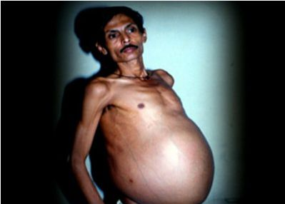 Kỳ lạ, người đàn ông mang thai suốt 36 năm