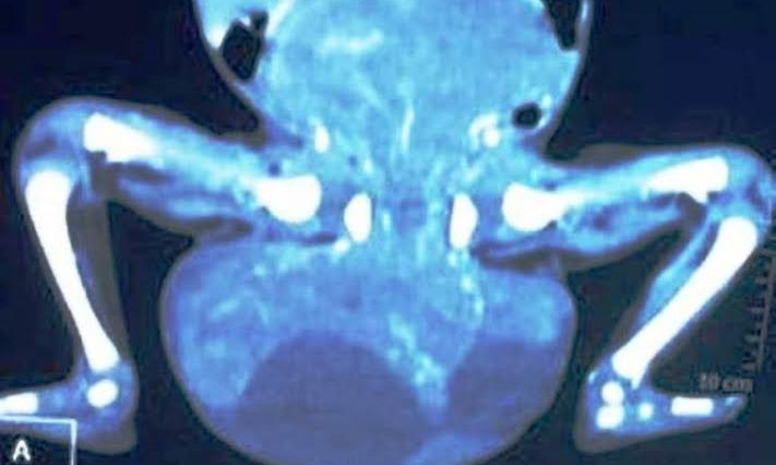 Khối u quái lớn ở vùng cùng cụt của cháu bé sơ sinh 20 ngày tuổi khi chưa phẫu thuật nhìn qua hình chụp phim âm bản. 