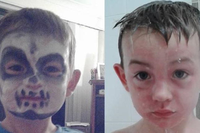 Bỏng da mặt sau khi trang điểm chơi Halloween