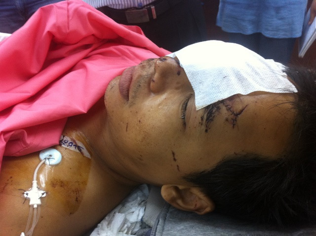 ông Bùi Văn Thìn (39 tuổi) bị vỡ nhãn cầu mắt phải do vụ nổ. Ảnh: Quốc Ngọc.