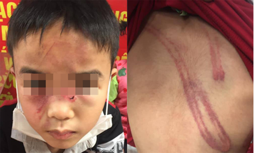 Hình ảnh cháu bé bị đánh chia sẻ trên mạng xã hội.