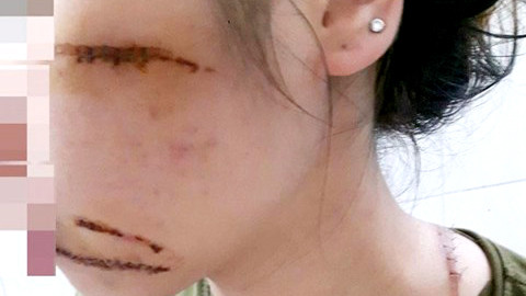 Chị Hạnh bị nhóm côn đồ chém trọng thương