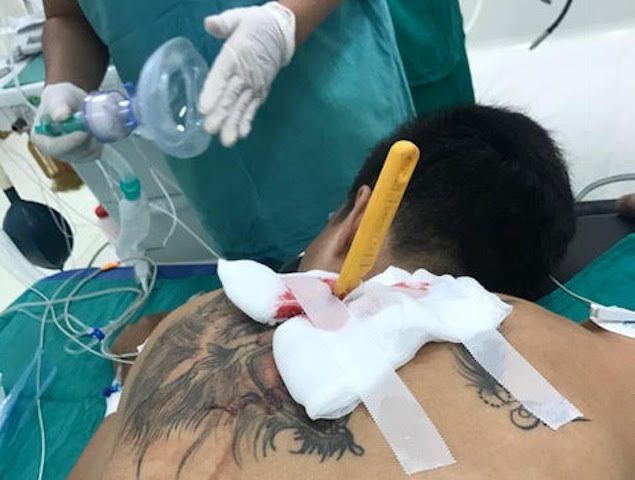 Nam thanh niên bị bạn gái cầm dao đâm lút cán