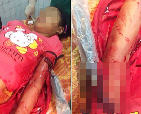 Bé D. được người dân đưa đến bệnh viện với con dao vẫn đang cắm ngập vào bắp tay trái. Ảnh N.L.