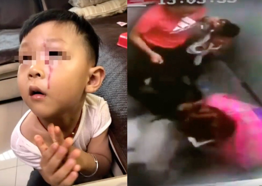 Cháu bé với vết thương trên mặt.