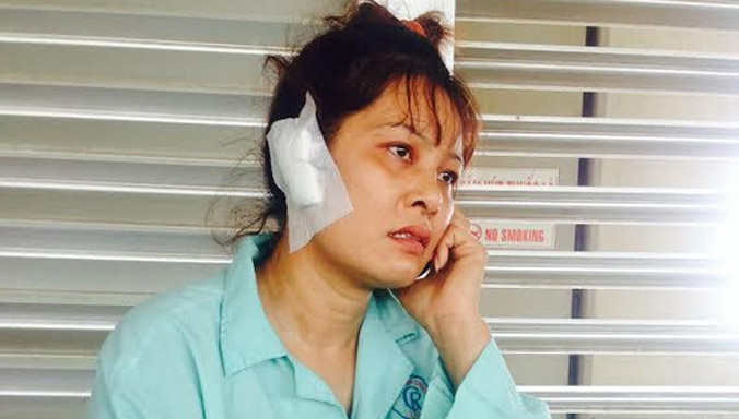 Chị Xuân bị chồng cắn rớt tai phải.