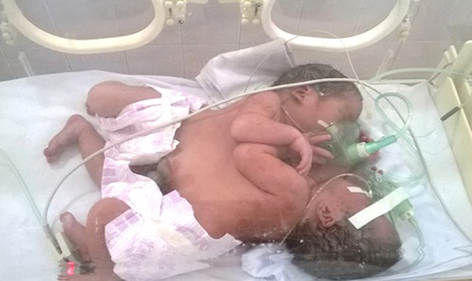 Cặp song sinh dính liền khi được điều trị tại Bệnh viện Việt Đức.