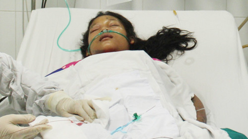 Ny bị ong vò vẽ đốt hơn 100 mũi, phải điều trị bằng phương pháp lọc máu