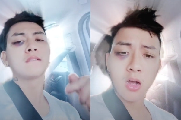 Showbiz 3/9: Hoài Lâm xuất hiện với gương mặt bầm tím gây hoang mang 