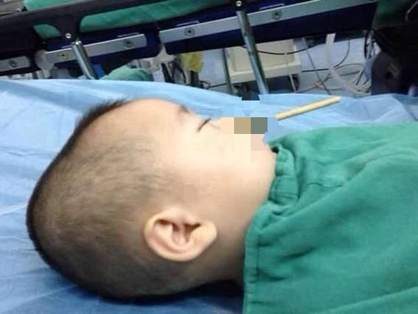 Các bác sĩ phải mất 4 tiếng phẫu thuật để lấy chiếc đũa ra. Nguồn: Mirror