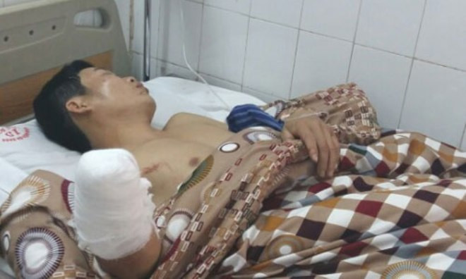 Bệnh nhân bị cụt tay
