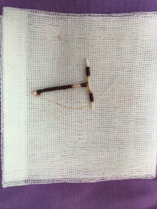 Vòng tránh thai được lấy ra khỏi bụng bệnh nhân. Ảnh bệnh viện cung cấp 