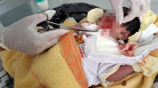 Cháu bé được các bác sĩ cấp cứu hô hấp, rửa vết thương trên mặt. Ảnh: Người Lao Động