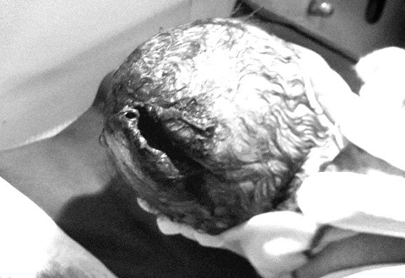 Bé trai chào đời với vết rách dài, rộng ở trên da đầu. Ảnh: Bệnh viện cung cấp