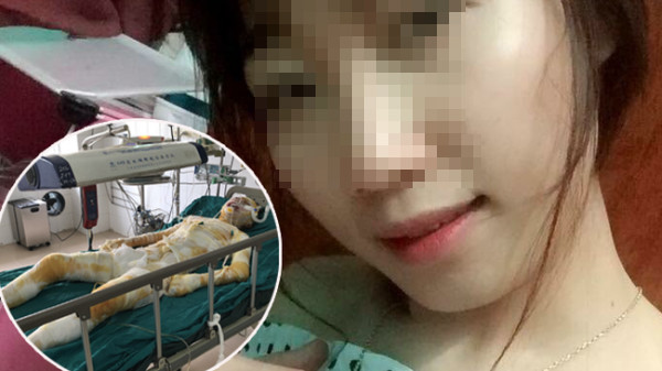 Chị H trước và sau khi bị tẩm xăng đốt