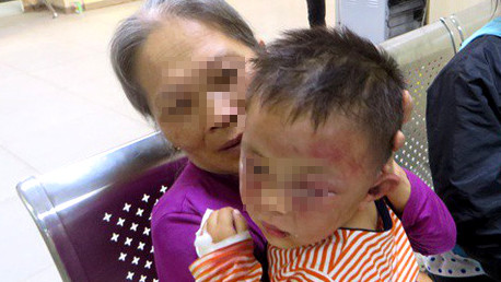 Khuôn mặt cháu H. bị thâm tím trông rất đau lòng