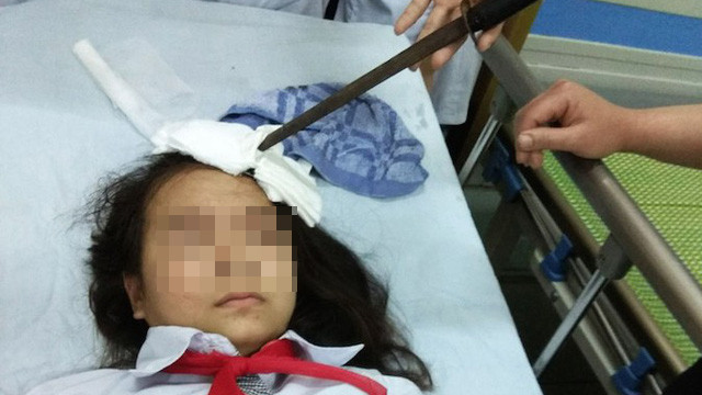 Cháu N.T.H lúc mới nhập viện trong tình trạng dao cắm vào trán. Ảnh: báo Hà Nam