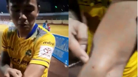 V.League tái hiện vụ Suarez cắn tay Ivanovic