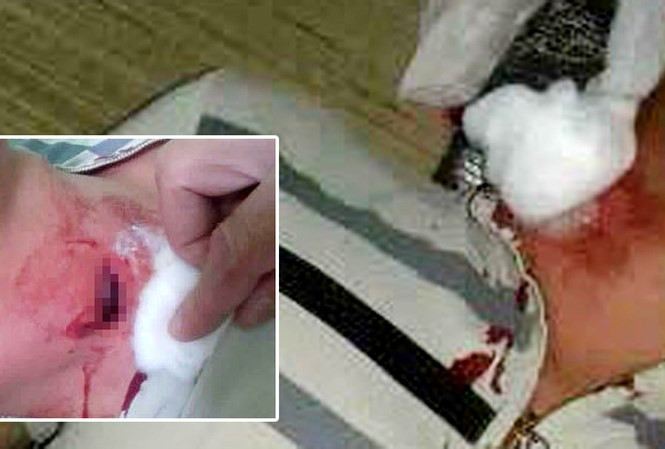 Nạn nhân bị vết thương ở cổ nghi viên đạn găm vào. Ảnh: VnExpress.