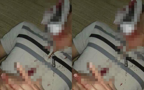 Nam thanh niên bị dị vật găm vào cổ.