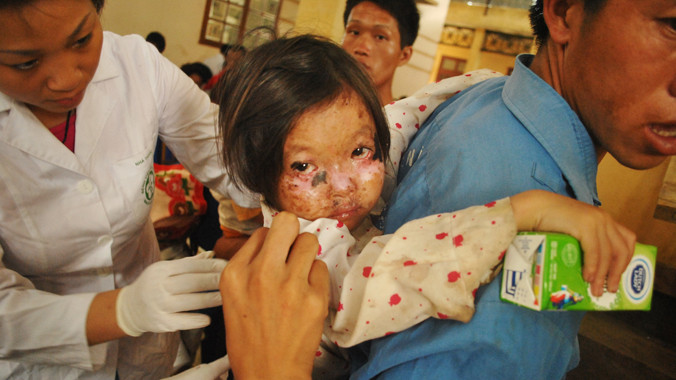  Bé Giàng A Dua (dân tộc Mông) được nhóm Hành trình niềm vui phát hiện và vận động đưa về Hà Nội chữa bệnh. Ảnh: Trần Hoàng