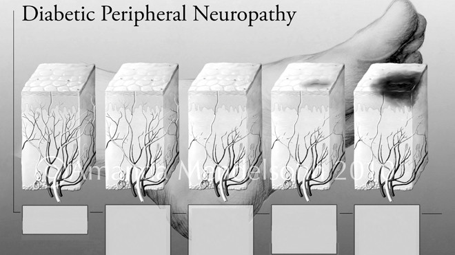 Biến chứng thần kinh do đái tháo đường