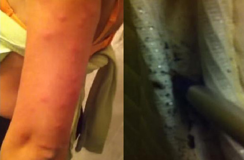 Những nốt rận cắn trên tay bạn gái Ozlen (trái) và ổ rệp dưới đệm (phải).