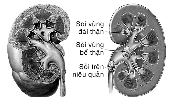 Sỏi thận - Ngăn ngừa tái phát trong điều trị