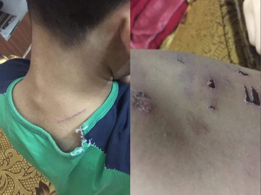 Vết thương trên người cháu N.