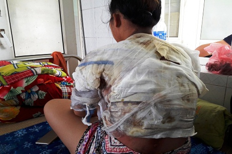 Chị Vui bị bỏng nhiều vị trí trên cơ thể
