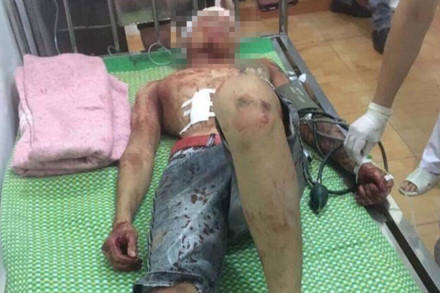 Nạn nhân bị côn đồ chém vỡ hộp sọ