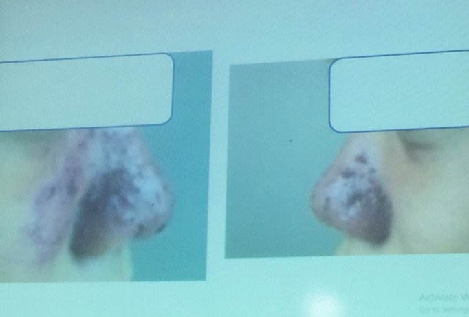 Bỏ ra 1,5 triệu để nâng mũi, hiện tại cô gái trẻ đã tốn hơn 30 triệu để điều trị biến chứng.