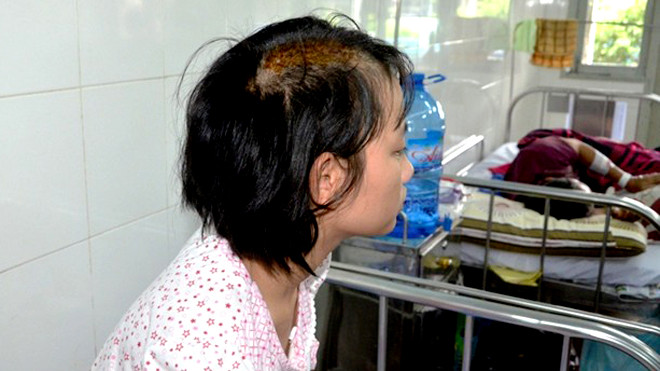 Bé Hoa với vết nứt sọ phải khâu 18 mũi trên đầu