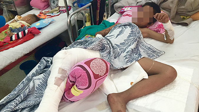 Đây là ca bị khỉ tấn công nghiêm trọng nhất mà bệnh viện Nhi Đồng 2 từng tiếp nhận. Ảnh: T.Chương.