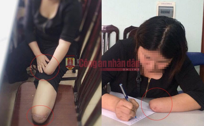 Chân, tay bị chặt đứt của chị N