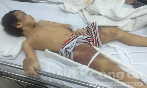 Toàn thân bé Thiện tím tái
