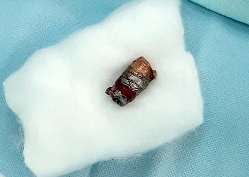 Viên đạn súng bút găm vào cổ nạn nhân được lấy ra