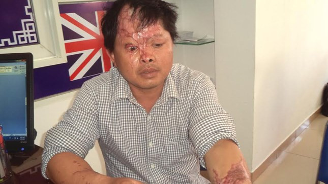 Đòn độc: Người vợ thuê tạt axít biến chồng thành tàn phế