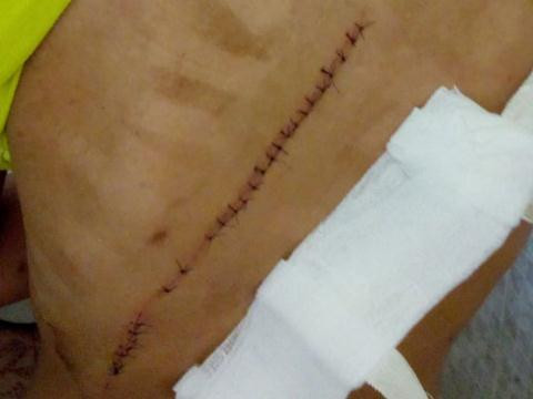 Vết thương trên vùng lưng chị T.