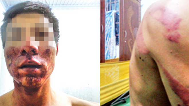Những vết thương trên người anh S.